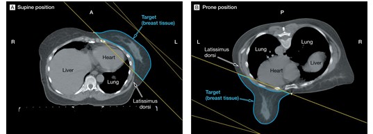 Prone Breast 