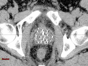 Prostate seed implant