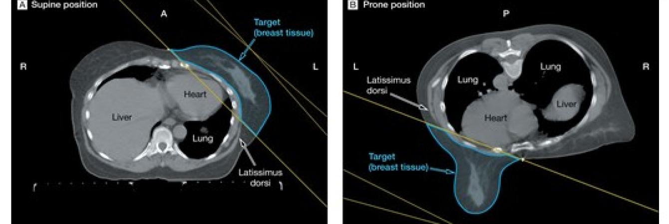 Prone Breast Scan